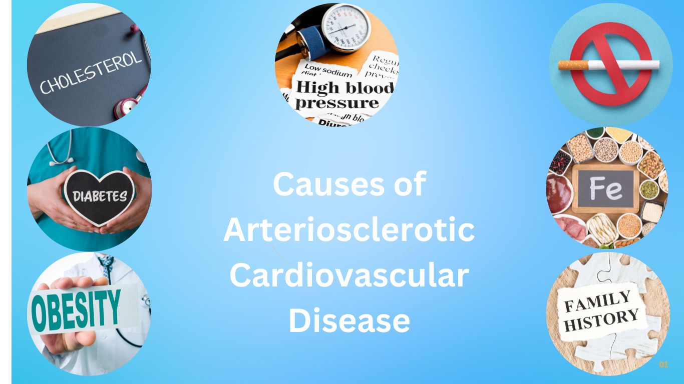 Cause of Arteriosclerotic Cardiovascular Disease